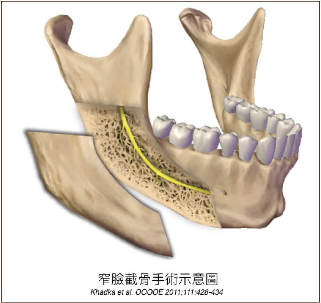 無痕削骨 聖緹雅醫美