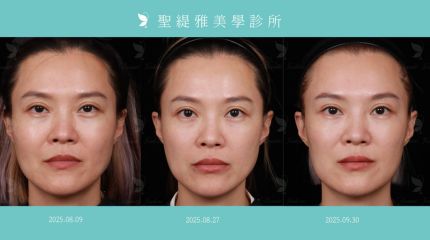 #聖緹雅美學｜40+女性 #逆時針 profhilo 真實案例！ 圖片